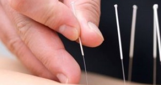 3 Ưu điểm khi dùng phương pháp Châm cứu chữa đau thần kinh tọa